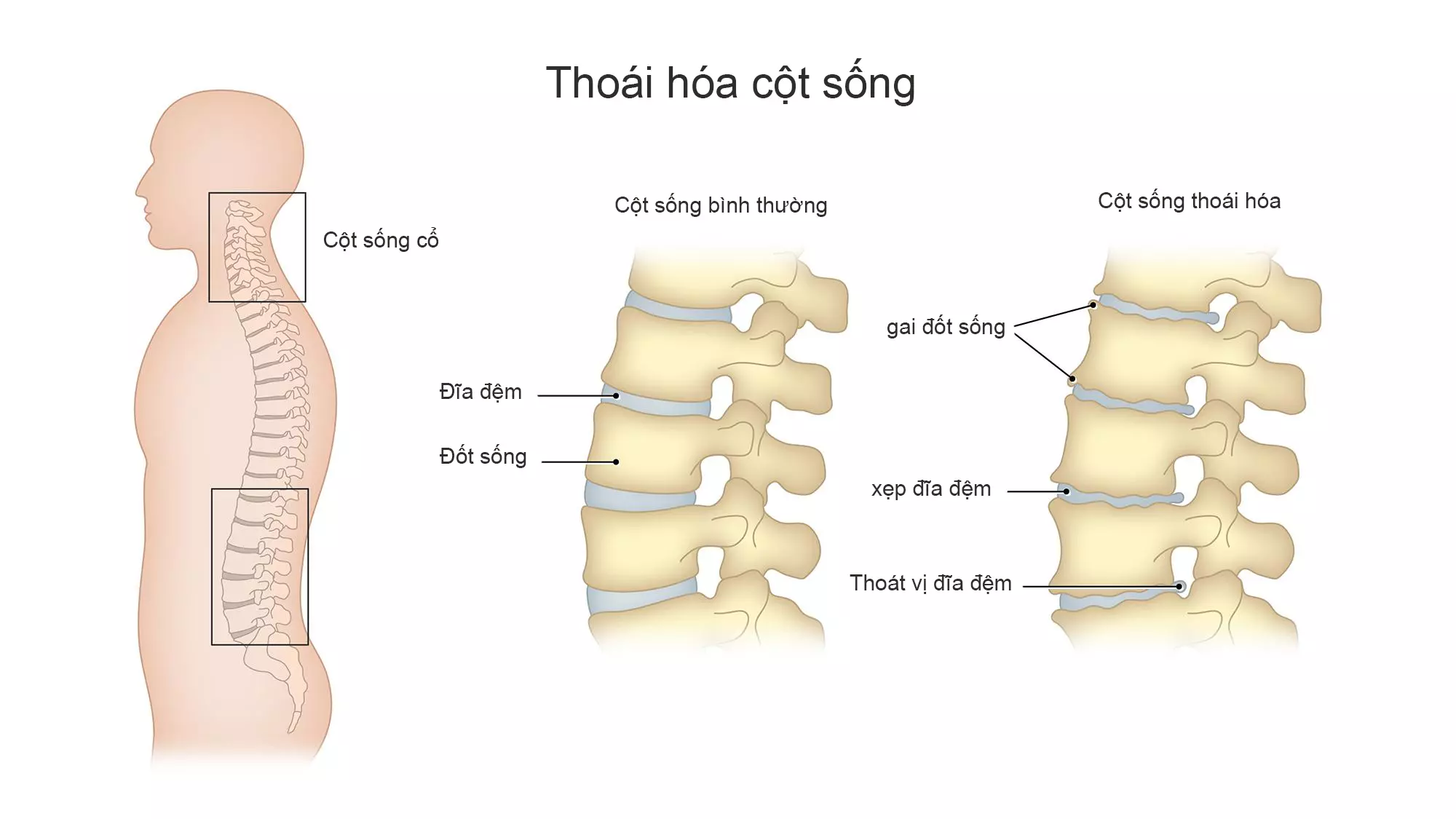 Thoái hóa cột sống cổ thường xảy ra ở vị trí C3, C4, C5, C6, C7